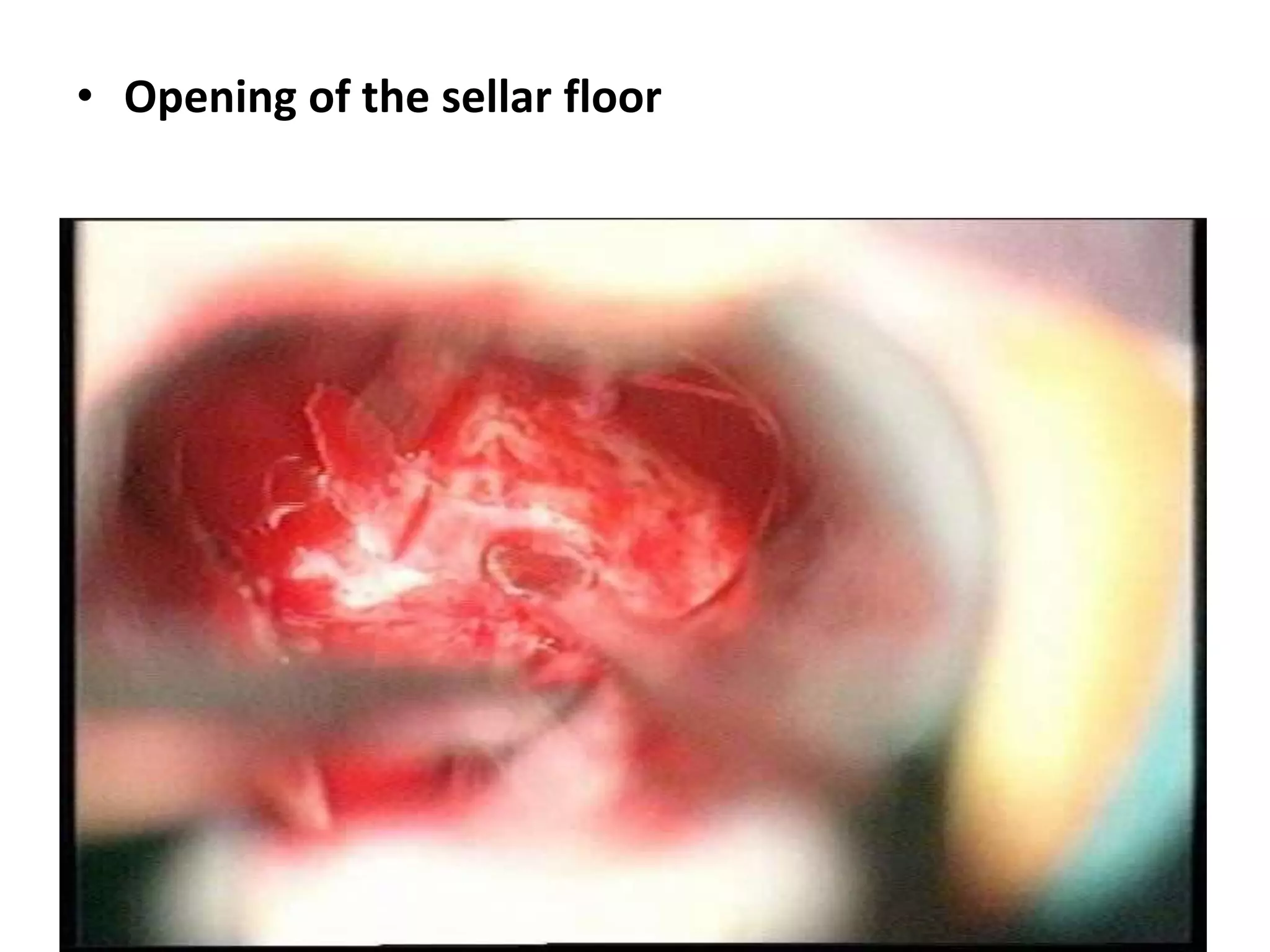 • Opening of the sellar floor
 