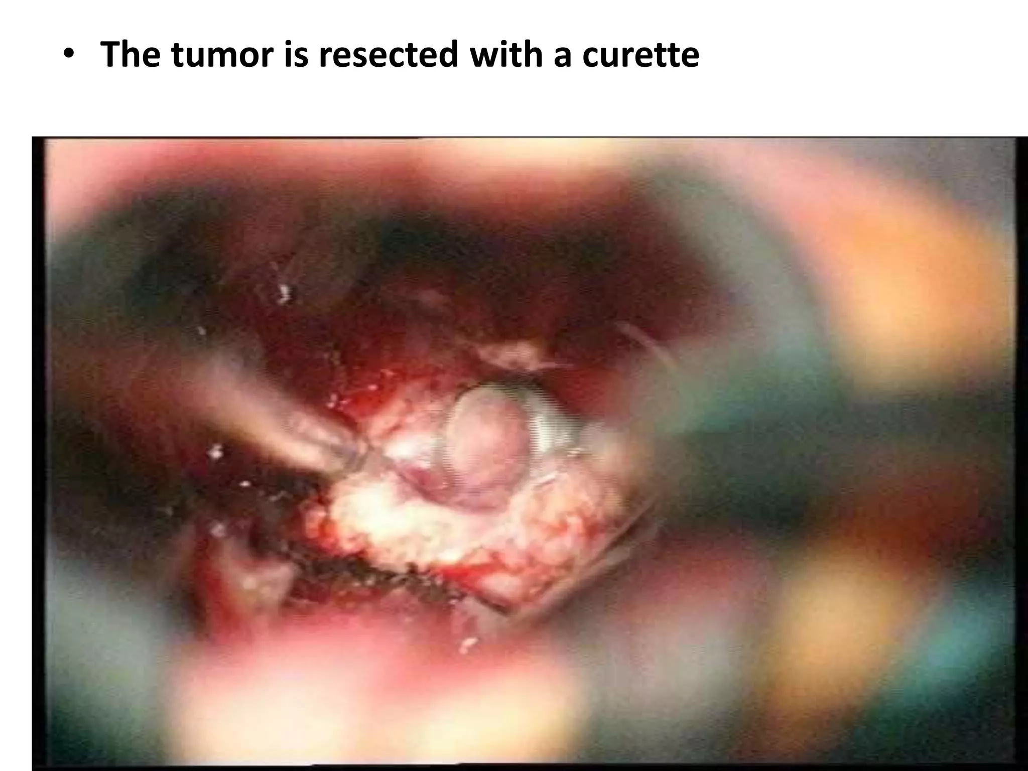 • The tumor is resected with a curette
 