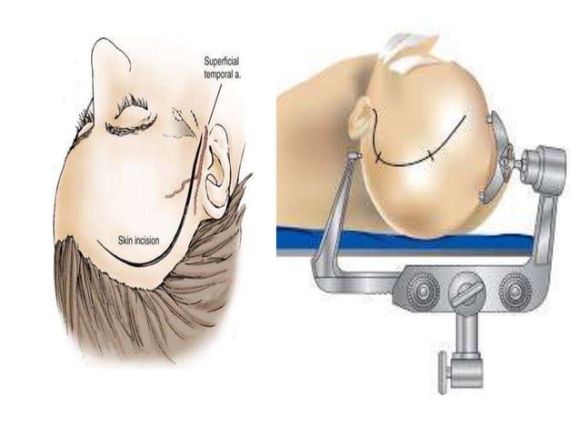 Transbasal Approach Surgical approaches to skull base | PPTX | Death, Injury, or Military ...
