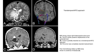 Surgical approach to thalamus | PPTX