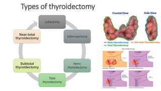 Surgical approach to thyroid and post operative care | PDF