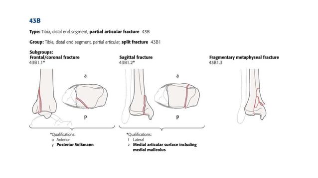 Surgical approaches tibia fibula | PPTX