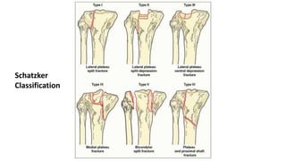Schatzker
Classification
 