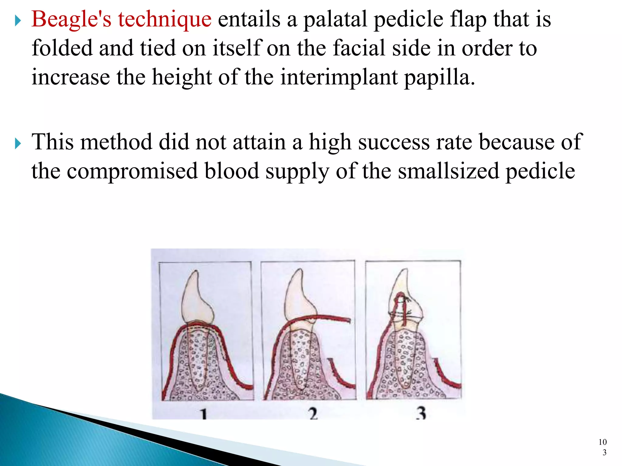  Beagle's technique entails a palatal pedicle flap that is
folded and tied on itself on the facial side in order to
increase the height of the interimplant papilla.
 This method did not attain a high success rate because of
the compromised blood supply of the smallsized pedicle
10
3
 