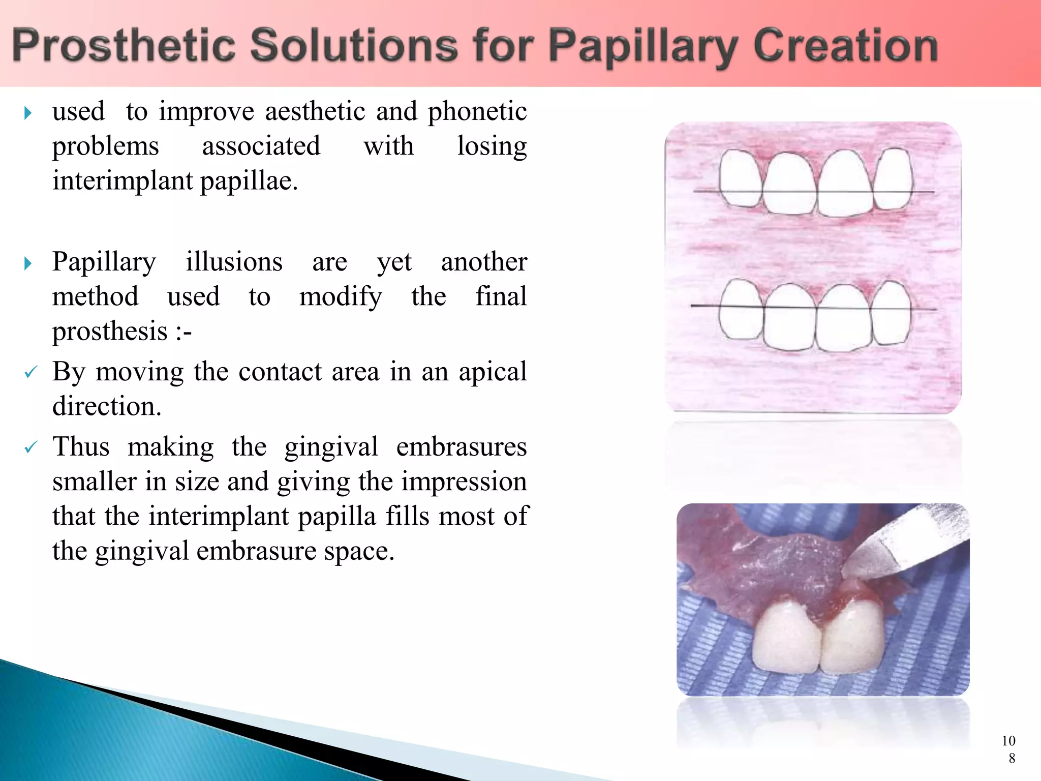  used to improve aesthetic and phonetic
problems associated with losing
interimplant papillae.
 Papillary illusions are yet another
method used to modify the final
prosthesis :-
 By moving the contact area in an apical
direction.
 Thus making the gingival embrasures
smaller in size and giving the impression
that the interimplant papilla fills most of
the gingival embrasure space.
10
8
 