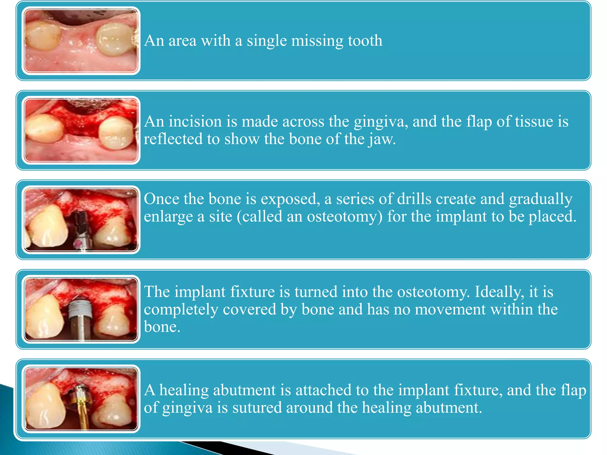 An area with a single missing tooth
An incision is made across the gingiva, and the flap of tissue is
reflected to show the bone of the jaw.
Once the bone is exposed, a series of drills create and gradually
enlarge a site (called an osteotomy) for the implant to be placed.
The implant fixture is turned into the osteotomy. Ideally, it is
completely covered by bone and has no movement within the
bone.
A healing abutment is attached to the implant fixture, and the flap
of gingiva is sutured around the healing abutment.
 