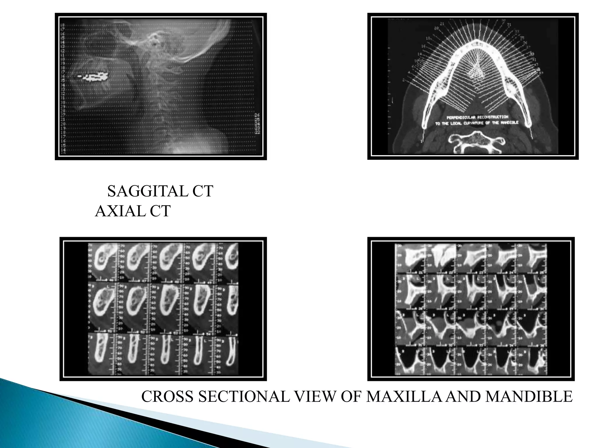 SAGGITAL CT
AXIAL CT
CROSS SECTIONAL VIEW OF MAXILLAAND MANDIBLE
 