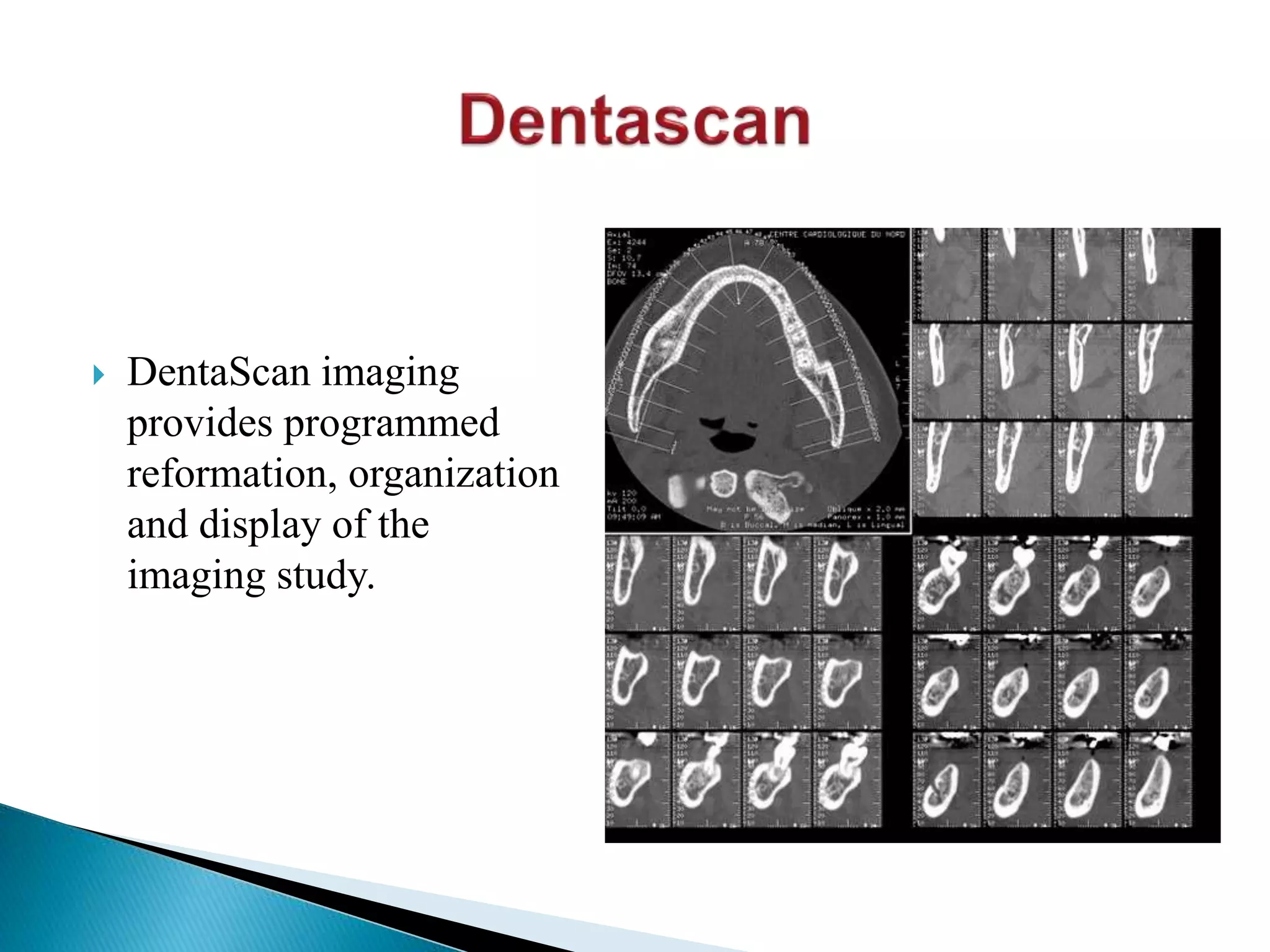  DentaScan imaging
provides programmed
reformation, organization
and display of the
imaging study.
 