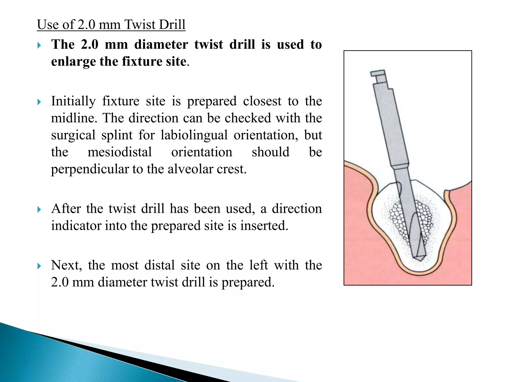 Use of 2.0 mm Twist Drill
 The 2.0 mm diameter twist drill is used to
enlarge the fixture site.
 Initially fixture site is prepared closest to the
midline. The direction can be checked with the
surgical splint for labiolingual orientation, but
the mesiodistal orientation should be
perpendicular to the alveolar crest.
 After the twist drill has been used, a direction
indicator into the prepared site is inserted.
 Next, the most distal site on the left with the
2.0 mm diameter twist drill is prepared.
 