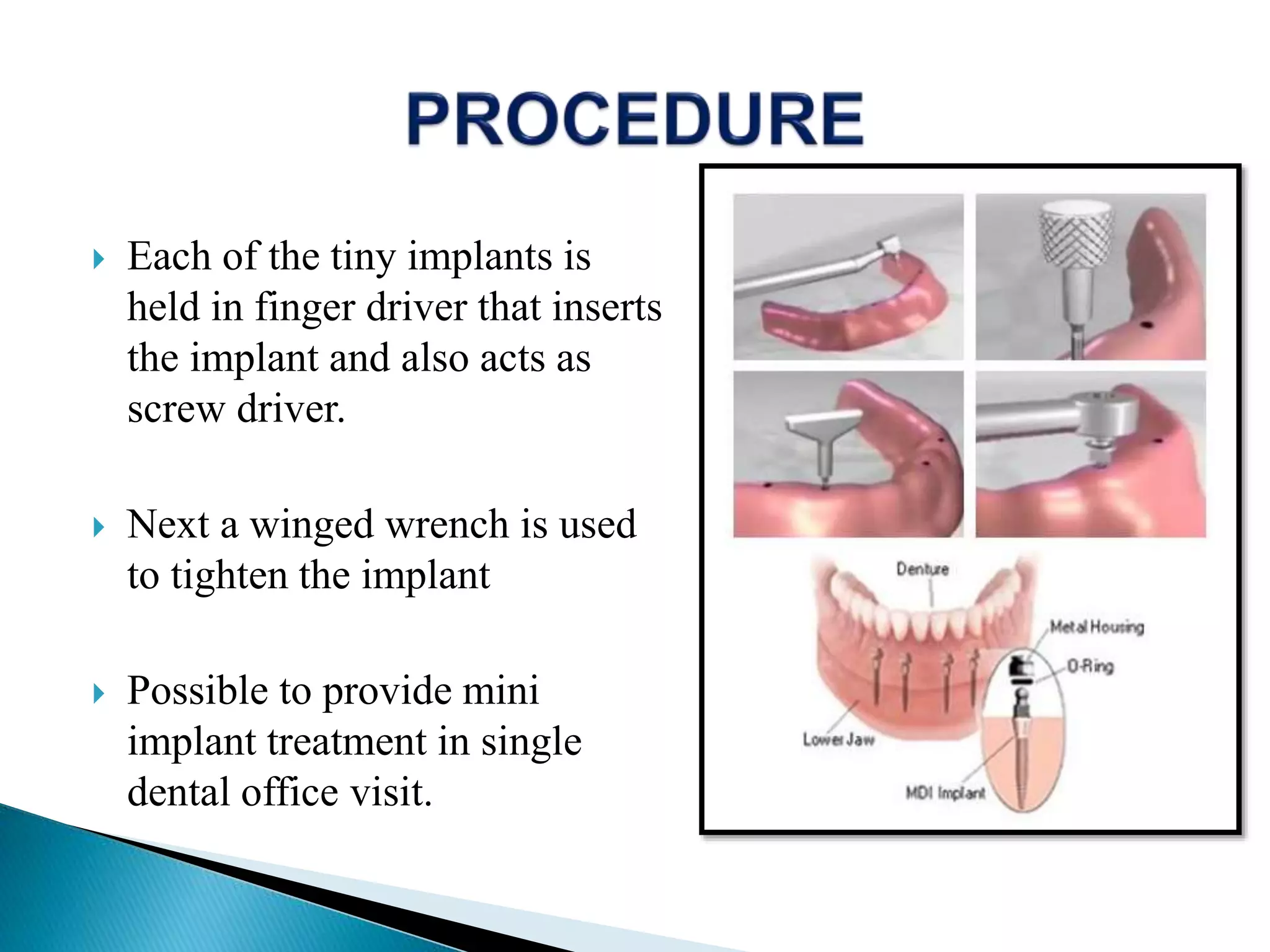 Each of the tiny implants is
held in finger driver that inserts
the implant and also acts as
screw driver.
 Next a winged wrench is used
to tighten the implant
 Possible to provide mini
implant treatment in single
dental office visit.
 