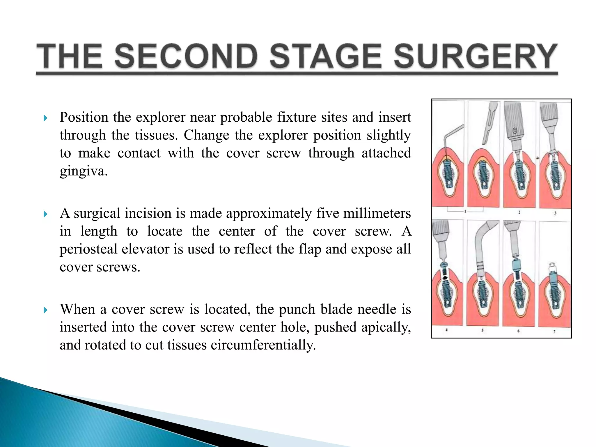  Position the explorer near probable fixture sites and insert
through the tissues. Change the explorer position slightly
to make contact with the cover screw through attached
gingiva.
 A surgical incision is made approximately five millimeters
in length to locate the center of the cover screw. A
periosteal elevator is used to reflect the flap and expose all
cover screws.
 When a cover screw is located, the punch blade needle is
inserted into the cover screw center hole, pushed apically,
and rotated to cut tissues circumferentially.
 