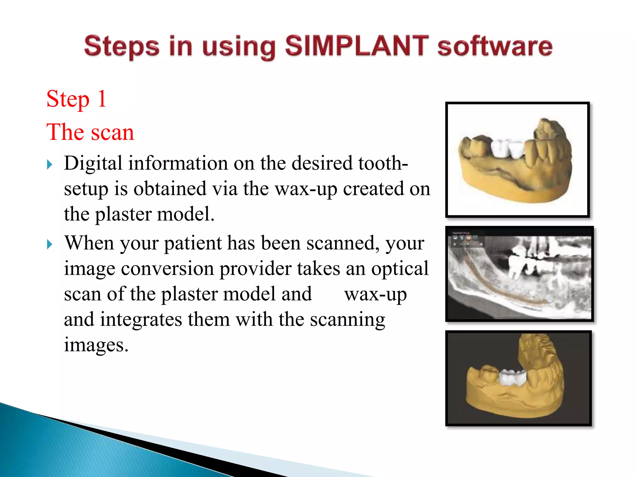 Step 1
The scan
 Digital information on the desired tooth-
setup is obtained via the wax-up created on
the plaster model.
 When your patient has been scanned, your
image conversion provider takes an optical
scan of the plaster model and wax-up
and integrates them with the scanning
images.
 