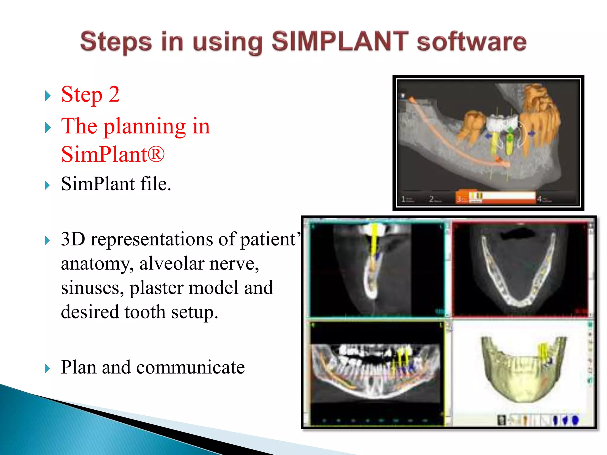  Step 2
 The planning in
SimPlant®
 SimPlant file.
 3D representations of patient’s
anatomy, alveolar nerve,
sinuses, plaster model and
desired tooth setup.
 Plan and communicate
 