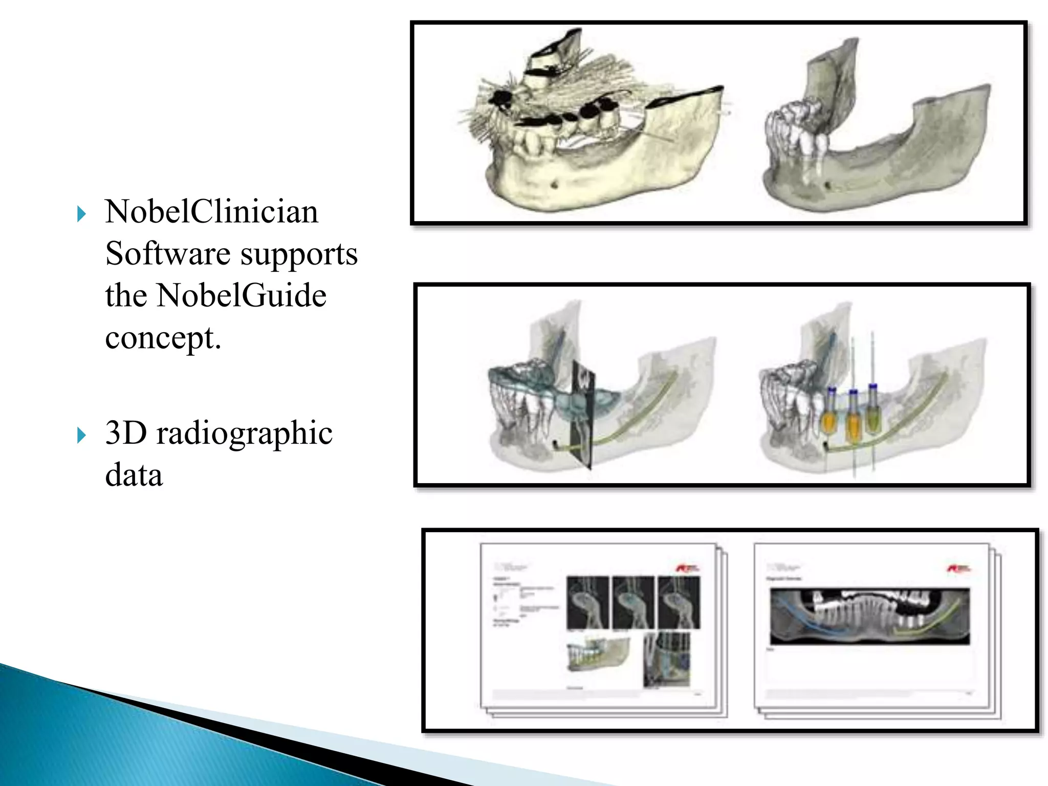  NobelClinician
Software supports
the NobelGuide
concept.
 3D radiographic
data
 