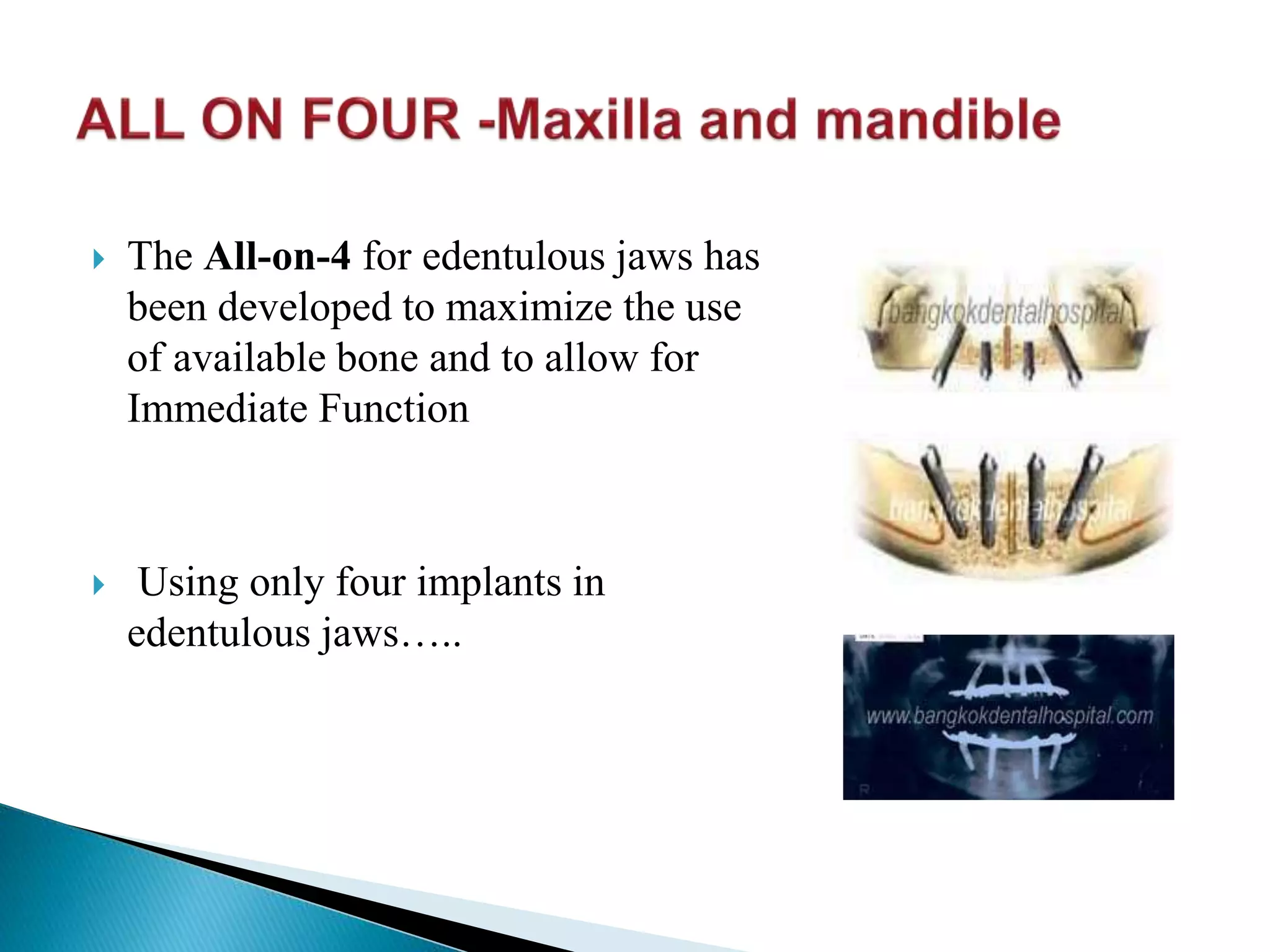  The All-on-4 for edentulous jaws has
been developed to maximize the use
of available bone and to allow for
Immediate Function
 Using only four implants in
edentulous jaws…..
 