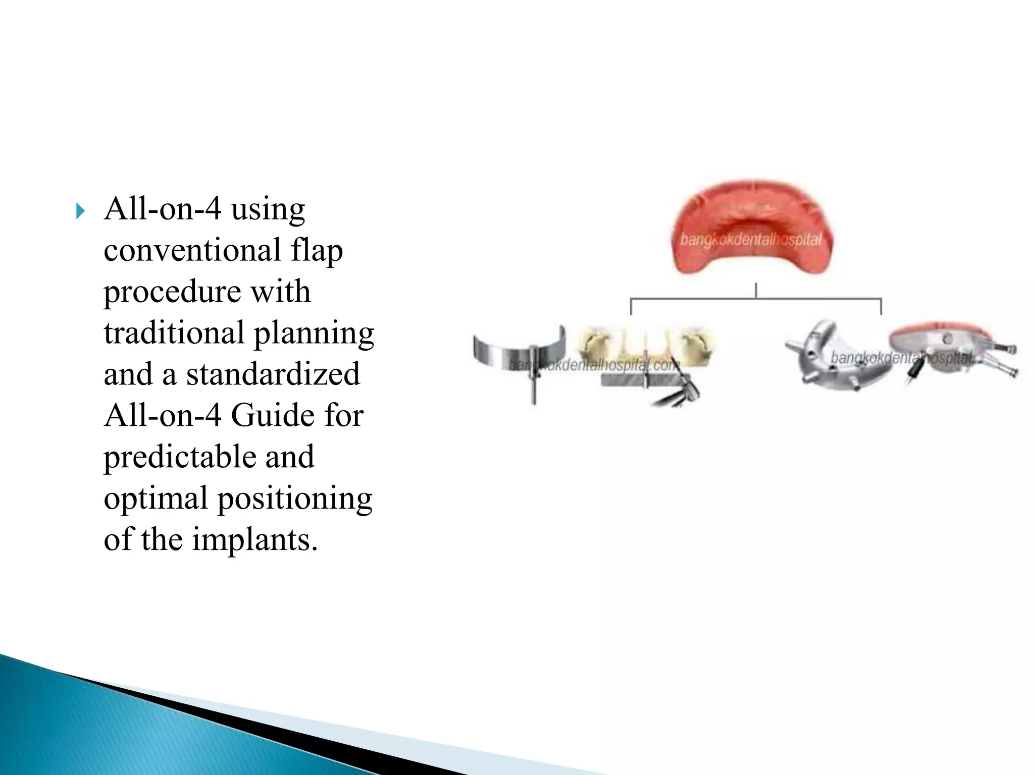  All-on-4 using
conventional flap
procedure with
traditional planning
and a standardized
All-on-4 Guide for
predictable and
optimal positioning
of the implants.
 