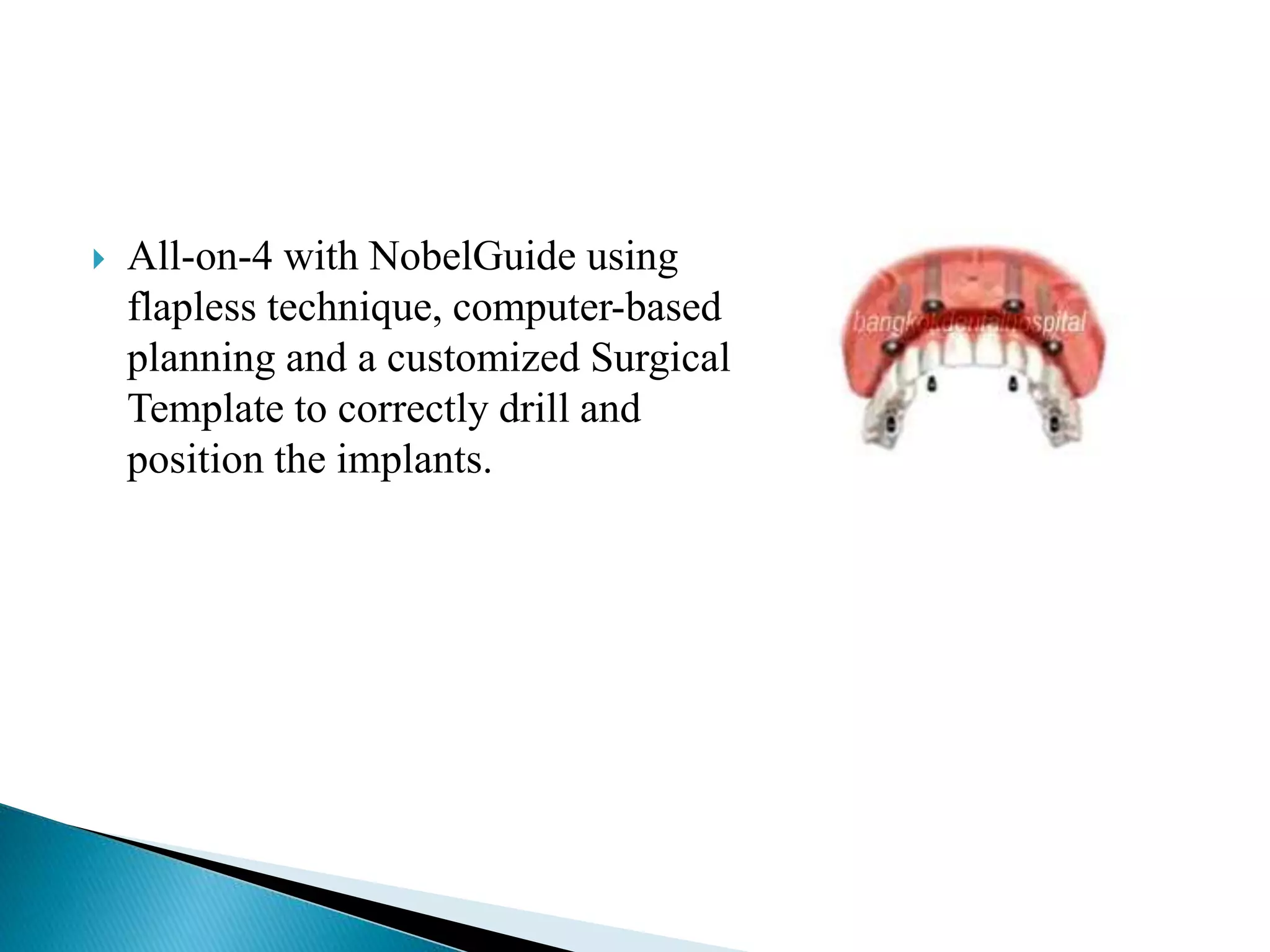  All-on-4 with NobelGuide using
flapless technique, computer-based
planning and a customized Surgical
Template to correctly drill and
position the implants.
 