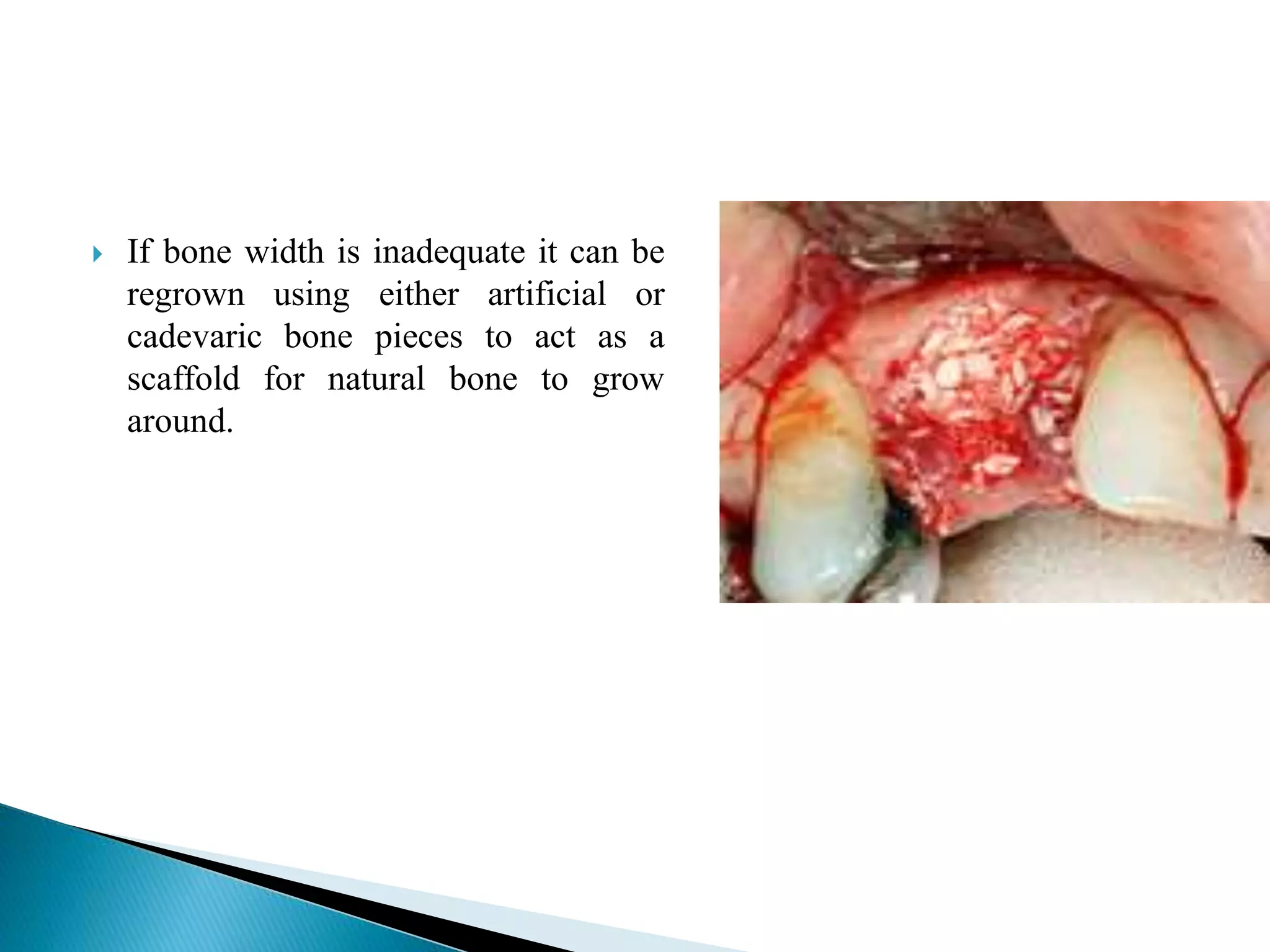  If bone width is inadequate it can be
regrown using either artificial or
cadevaric bone pieces to act as a
scaffold for natural bone to grow
around.
 