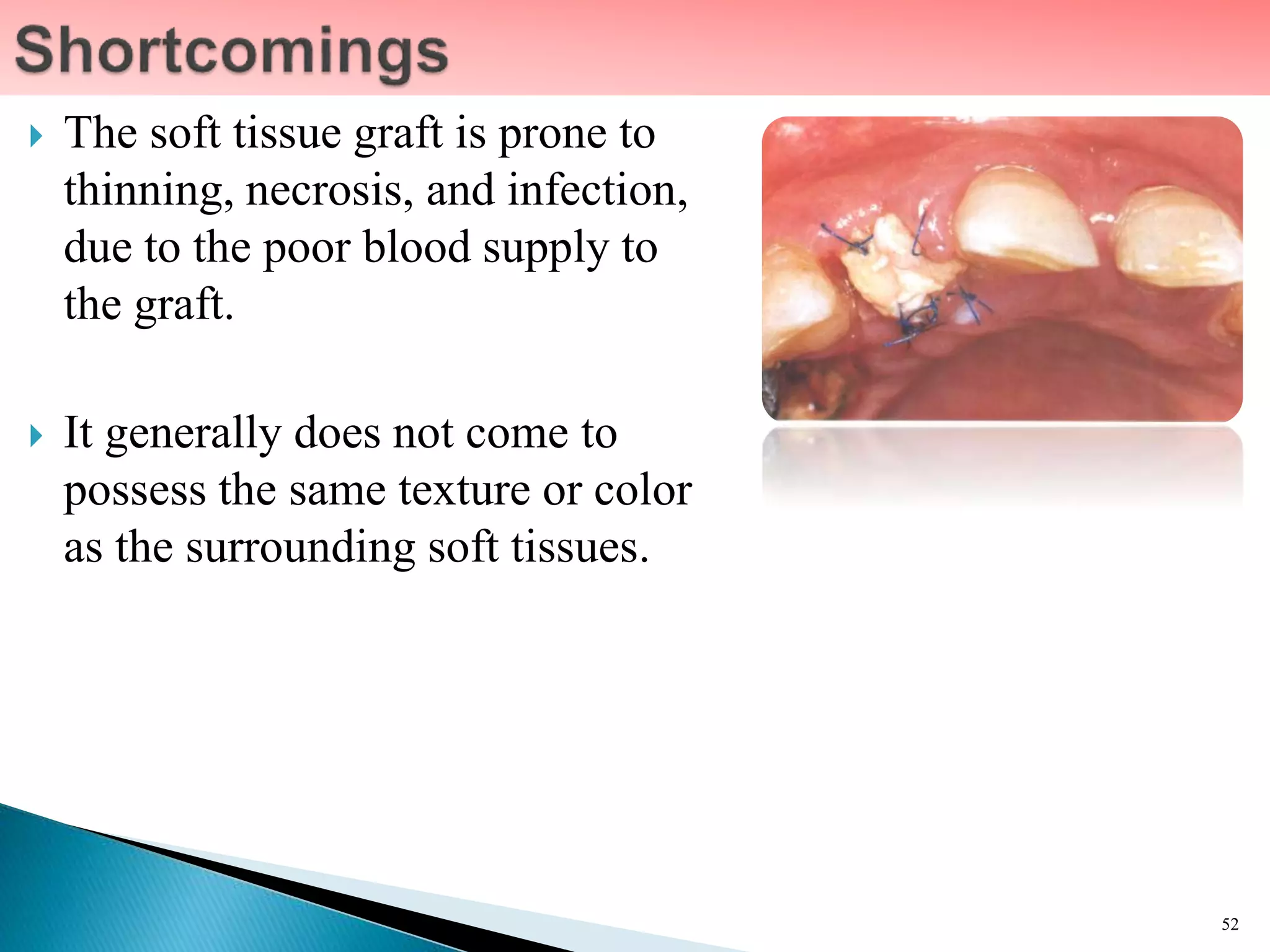  The soft tissue graft is prone to
thinning, necrosis, and infection,
due to the poor blood supply to
the graft.
 It generally does not come to
possess the same texture or color
as the surrounding soft tissues.
52
 