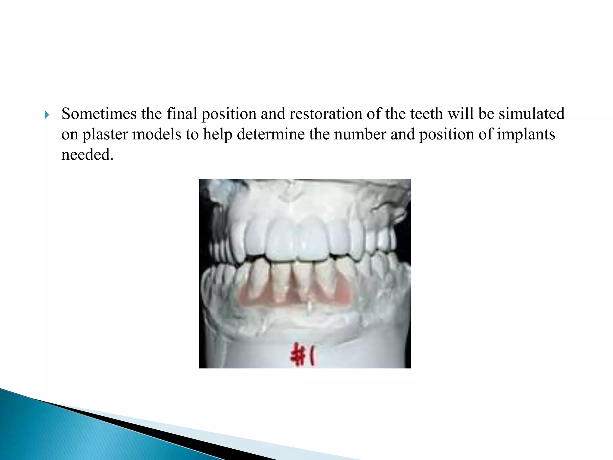  Sometimes the final position and restoration of the teeth will be simulated
on plaster models to help determine the number and position of implants
needed.
 
