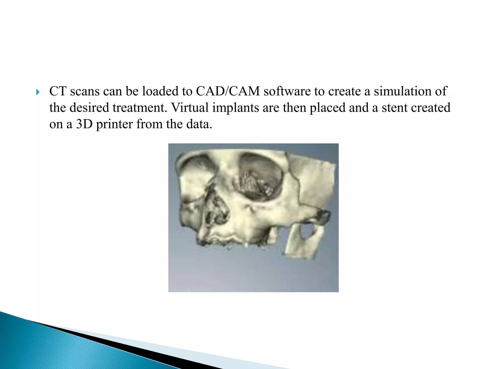  CT scans can be loaded to CAD/CAM software to create a simulation of
the desired treatment. Virtual implants are then placed and a stent created
on a 3D printer from the data.
 