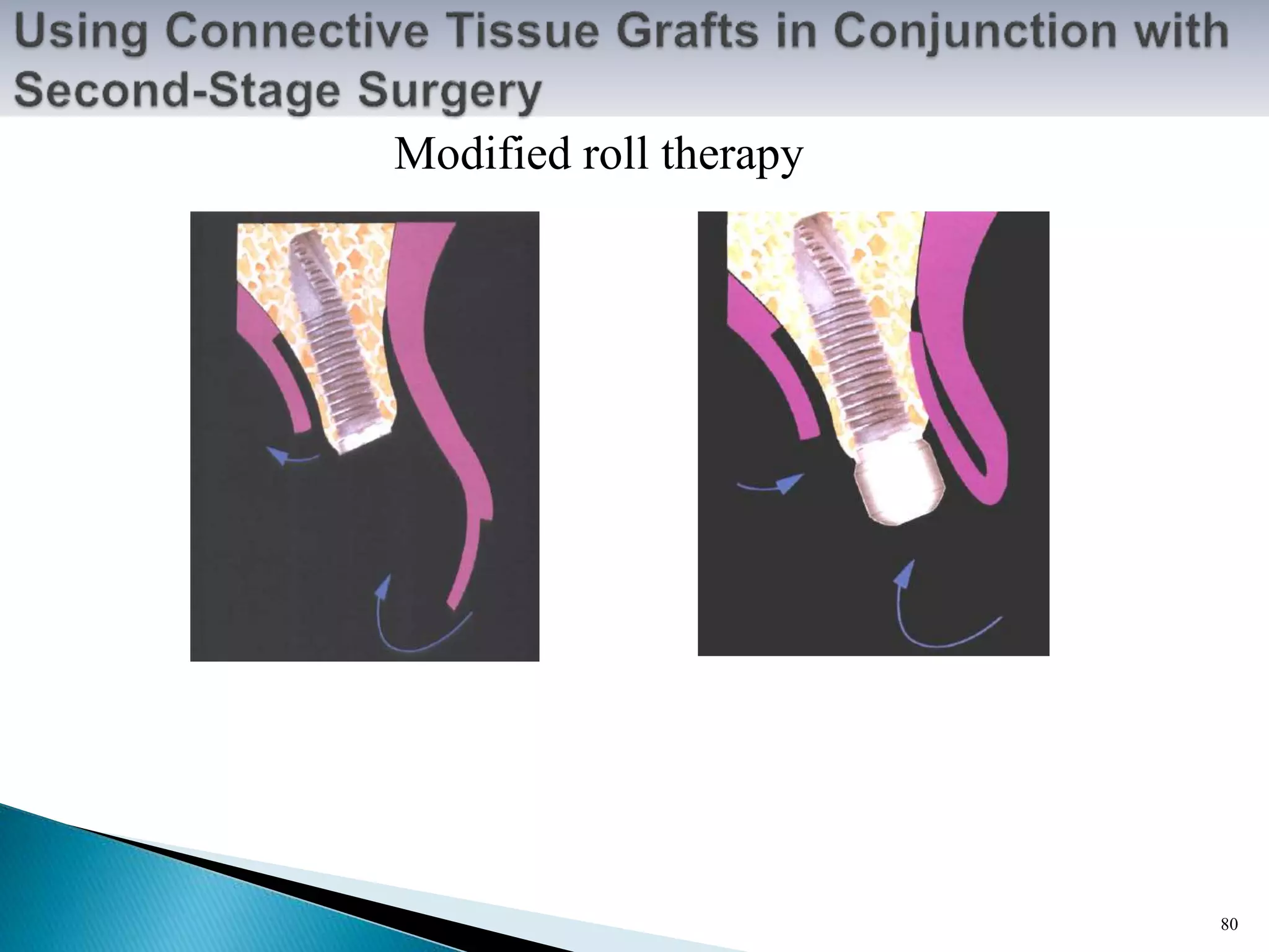 Modified roll therapy
80
 
