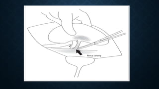 Surgical aspects complications of renal transplant.pptx