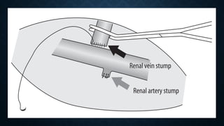 Surgical aspects complications of renal transplant.pptx