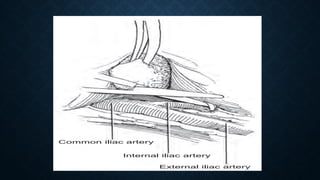 Surgical aspects complications of renal transplant.pptx
