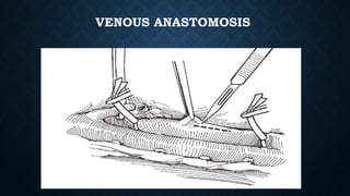 Surgical aspects complications of renal transplant.pptx