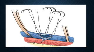 Surgical aspects complications of renal transplant.pptx