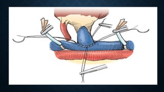 Surgical aspects complications of renal transplant.pptx
