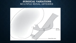 Surgical aspects complications of renal transplant.pptx