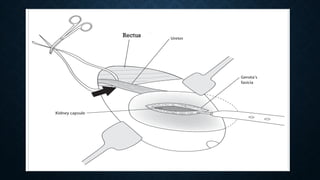 Surgical aspects complications of renal transplant.pptx