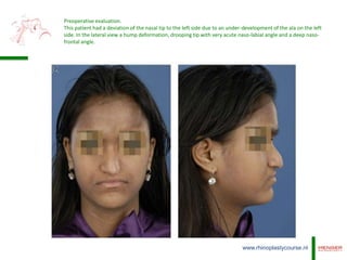 Surgical assessment in rhinoplasty | PPTX