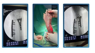 Comprehensive Orthopedic Case Studies: Fractures, Revisions, and ...