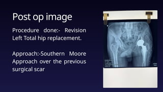 Moore Approach Comprehensive Orthopedic Case Studies: Fractures, Revisions, and ...