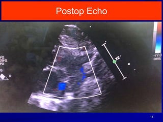 Postop Echo
14
 