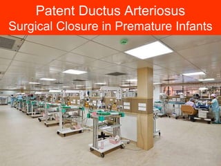 Patent Ductus Arteriosus
Surgical Closure in Premature Infants
1
 