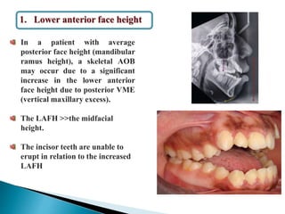 Surgical correction of anterior openbite | PPTX