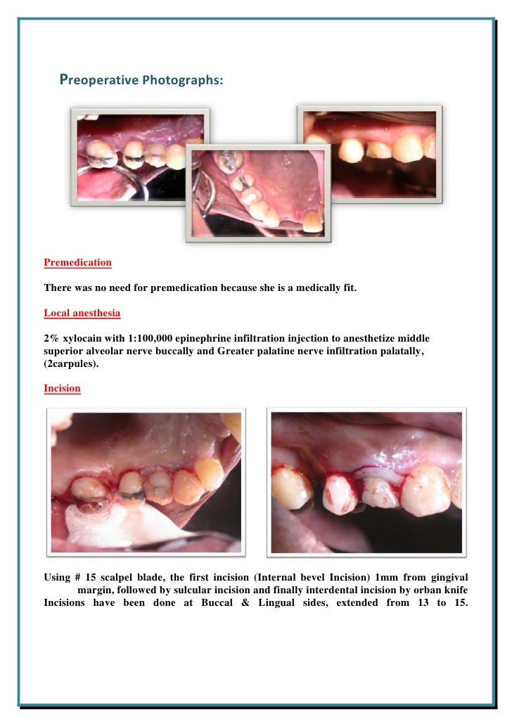Surgical Crown Lengthening 2