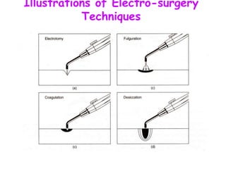 Illustrations of Electro-surgery
Techniques
 
