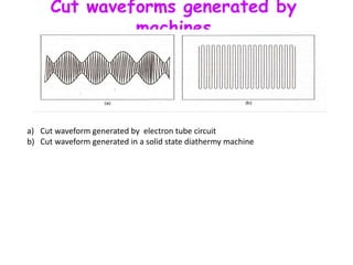 Cut waveforms generated by
machines
a) Cut waveform generated by electron tube circuit
b) Cut waveform generated in a solid state diathermy machine
 