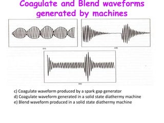 Coagulate and Blend waveforms
generated by machines
c) Coagulate waveform produced by a spark gap generator
d) Coagulate waveform generated in a solid state diathermy machine
e) Blend waveform produced in a solid state diathermy machine
 