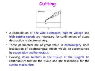 Types of Electrocautery & Principles of its use in Thermocoagulation
