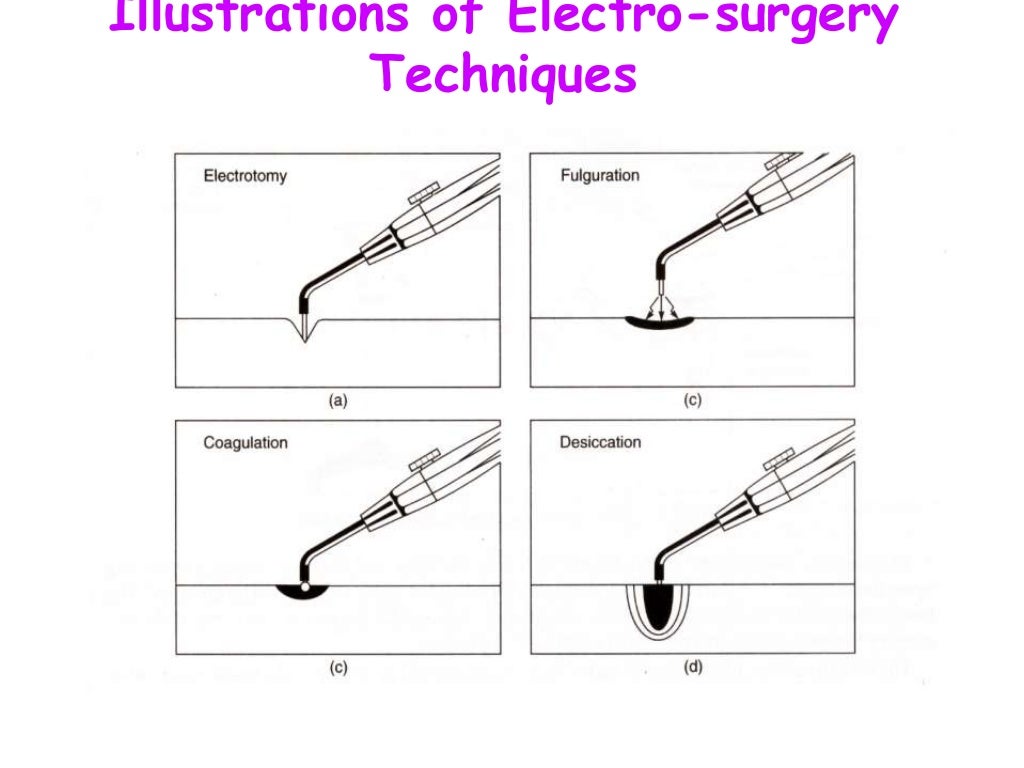 Surgical diathermy