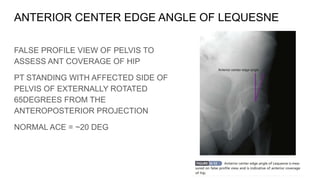 Standing False Profile SURGICAL DISLOCATION OF HIP:GANZ APPROACH, KOCHER LANGENBACK,GIBSON ...