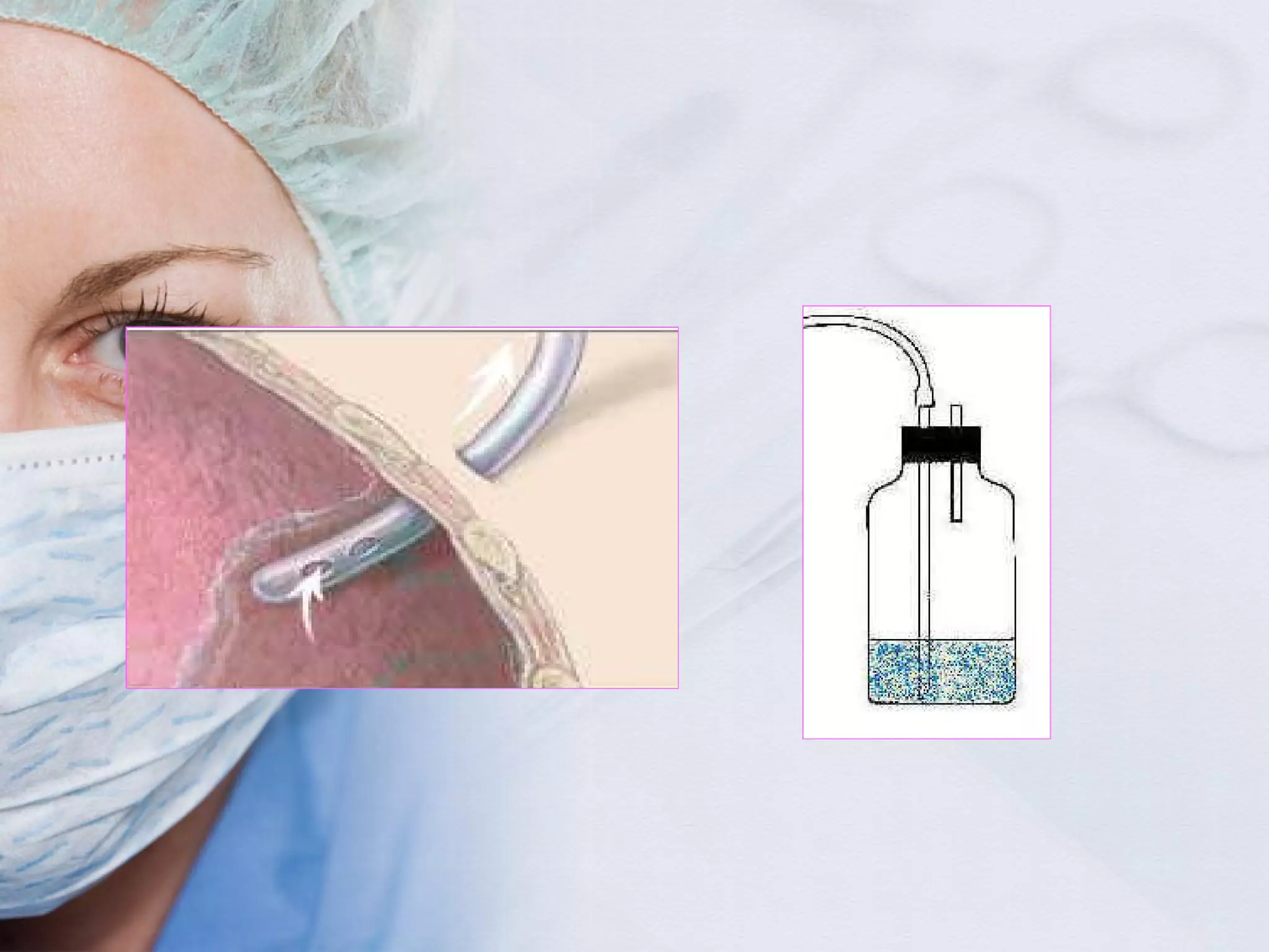 Surgical drains, tube, catheters and central lines | PPT