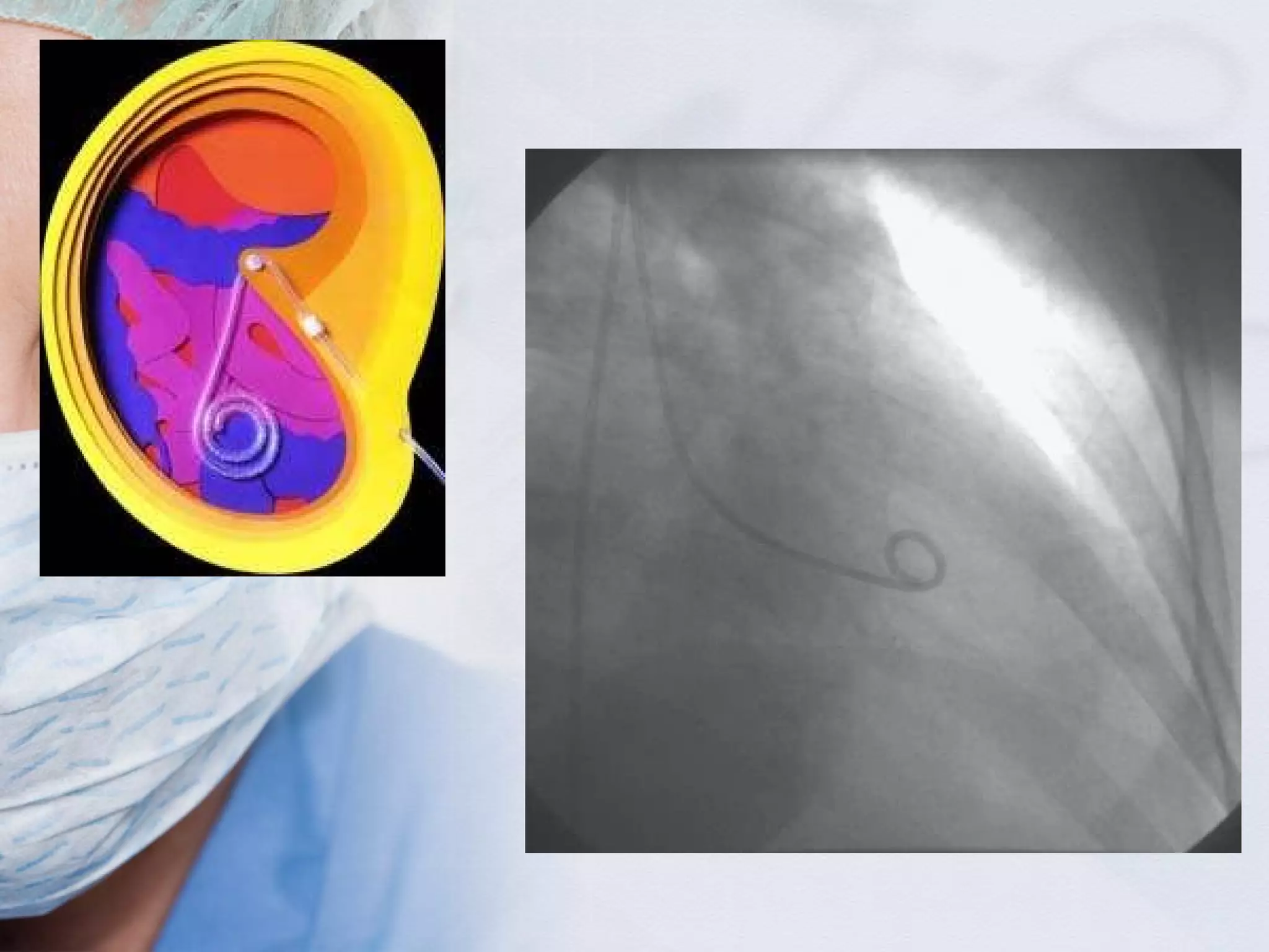 Surgical drains, tube, catheters and central lines | PPT