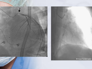 Tac Line Surgical drains, tube, catheters and central lines | PPT
